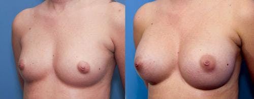 Breast Augmentation Before & After Gallery - Patient 58470447 - Image 3