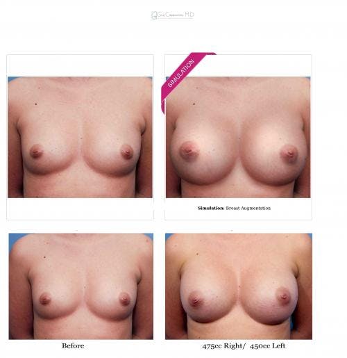Breast Augmentation Before & After Gallery - Patient 58470447 - Image 4