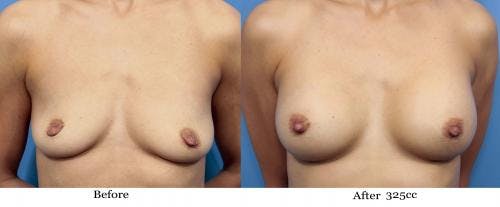 Breast Augmentation Before & After Gallery - Patient 58470448 - Image 1