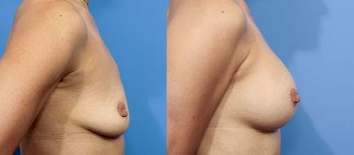 Breast Augmentation Before & After Gallery - Patient 58470448 - Image 2