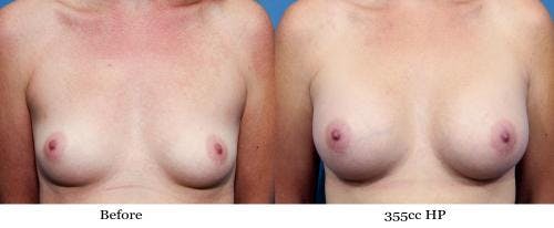Breast Augmentation Before & After Gallery - Patient 58470449 - Image 1