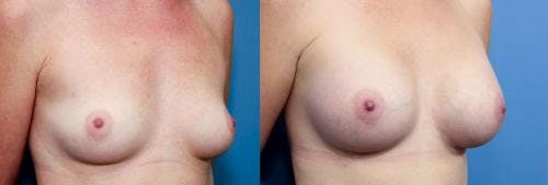Breast Augmentation Before & After Gallery - Patient 58470449 - Image 2