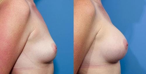 Breast Augmentation Before & After Gallery - Patient 58470449 - Image 3