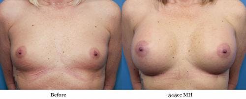 Breast Augmentation Before & After Gallery - Patient 58470451 - Image 1