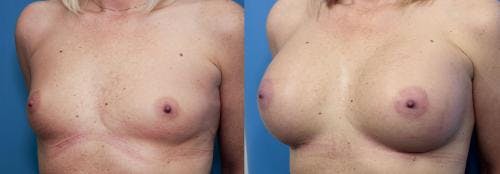 Breast Augmentation Before & After Gallery - Patient 58470451 - Image 2