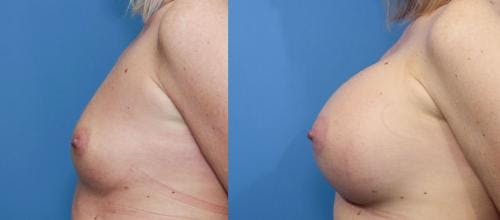 Breast Augmentation Before & After Gallery - Patient 58470451 - Image 3