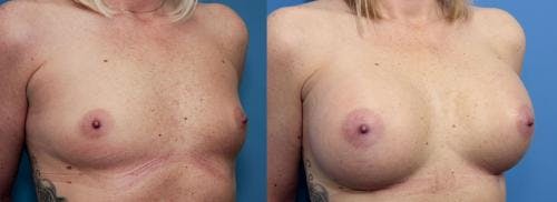 Breast Augmentation Before & After Gallery - Patient 58470451 - Image 4