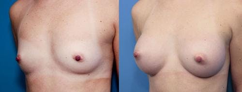 Breast Augmentation Before & After Gallery - Patient 58470453 - Image 2
