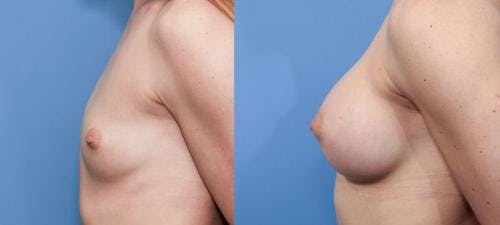 Breast Augmentation Before & After Gallery - Patient 58470455 - Image 2