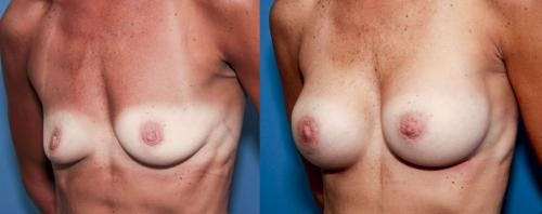 Breast Augmentation Before & After Gallery - Patient 58470456 - Image 1