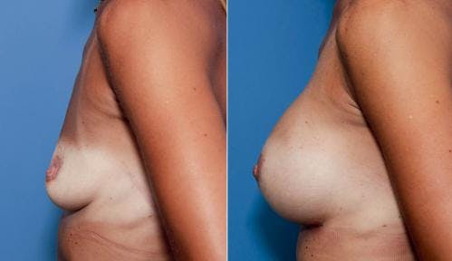 Breast Augmentation Before & After Gallery - Patient 58470456 - Image 2