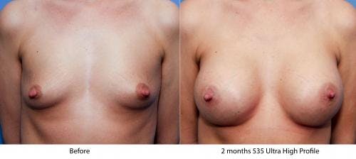 Breast Augmentation Before & After Gallery - Patient 58470458 - Image 1