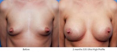 Breast Augmentation Before & After Gallery - Patient 58470458 - Image 1