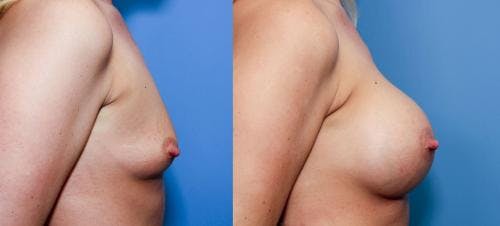 Breast Augmentation Before & After Gallery - Patient 58470458 - Image 2