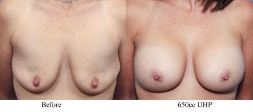 Breast Augmentation Before & After Gallery - Patient 58470459 - Image 1