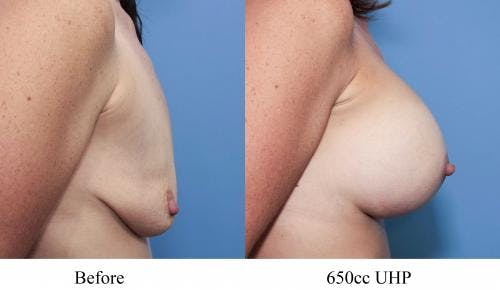 Breast Augmentation Before & After Gallery - Patient 58470459 - Image 2
