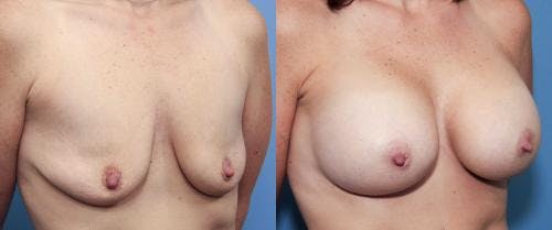 Breast Augmentation Before & After Gallery - Patient 58470459 - Image 3