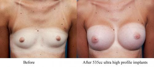 Breast Augmentation Before & After Gallery - Patient 58470460 - Image 1