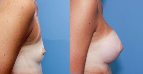 Breast Augmentation Before & After Gallery - Patient 58470460 - Image 2