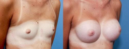 Breast Augmentation Before & After Gallery - Patient 58470460 - Image 3