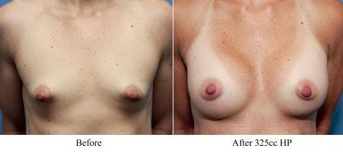 Breast Augmentation Before & After Gallery - Patient 58470463 - Image 3