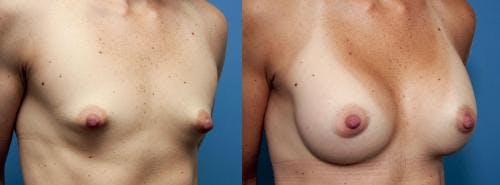 Breast Augmentation Before & After Gallery - Patient 58470463 - Image 4
