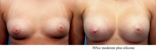 Breast Augmentation Before & After Gallery - Patient 58470465 - Image 1