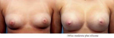 Breast Augmentation Before & After Gallery - Patient 58470465 - Image 1