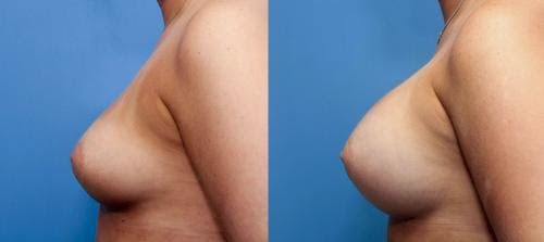Breast Augmentation Before & After Gallery - Patient 58470465 - Image 2