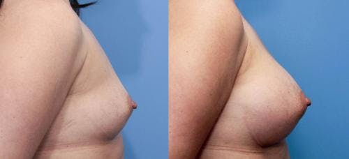 Breast Augmentation Before & After Gallery - Patient 58470466 - Image 2