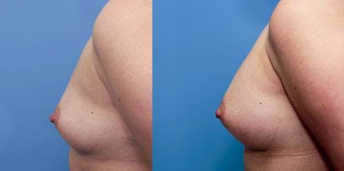 Breast Augmentation Before & After Gallery - Patient 58470466 - Image 3