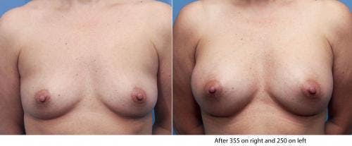 Breast Augmentation Before & After Gallery - Patient 58470466 - Image 1