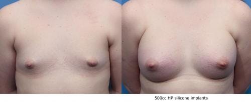Breast Augmentation Before & After Gallery - Patient 58470468 - Image 1