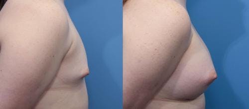 Breast Augmentation Before & After Gallery - Patient 58470468 - Image 2