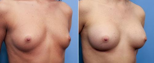 Breast Augmentation Before & After Gallery - Patient 58470469 - Image 1