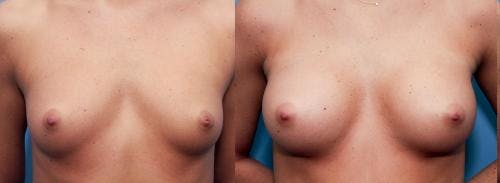 Breast Augmentation Gallery - Patient 58470469 - Image 2