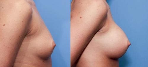 Breast Augmentation Before & After Gallery - Patient 58470469 - Image 3