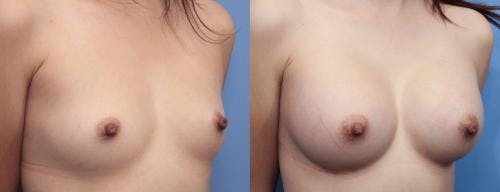 Breast Augmentation Before & After Gallery - Patient 58470470 - Image 2