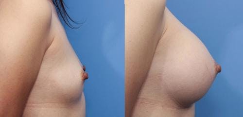 Breast Augmentation Before & After Gallery - Patient 58470470 - Image 3