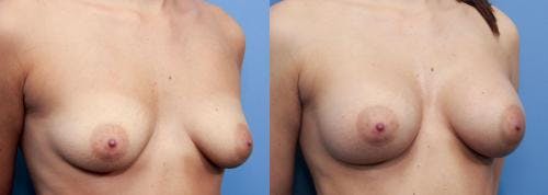 Breast Augmentation Before & After Gallery - Patient 58470471 - Image 2