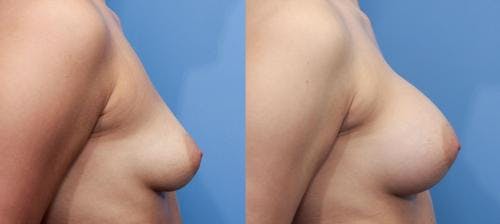 Breast Augmentation Before & After Gallery - Patient 58470471 - Image 3