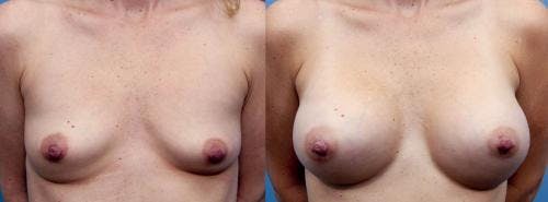 Breast Augmentation Before & After Gallery - Patient 58470472 - Image 1