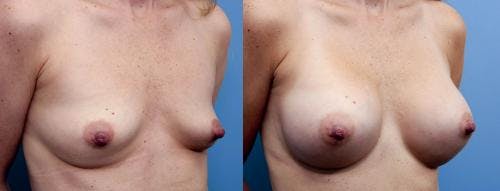 Breast Augmentation Before & After Gallery - Patient 58470472 - Image 2