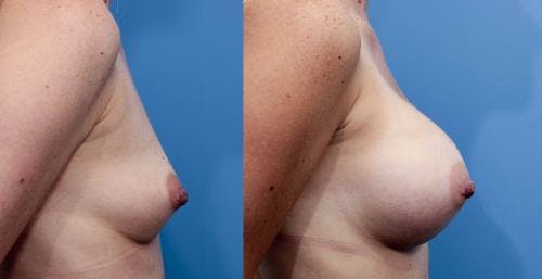 Breast Augmentation Before & After Gallery - Patient 58470472 - Image 3