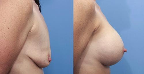 Breast Augmentation Before & After Gallery - Patient 58470474 - Image 2