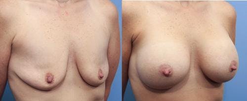 Breast Augmentation Before & After Gallery - Patient 58470474 - Image 3