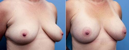 Breast Augmentation Before & After Gallery - Patient 58470475 - Image 2