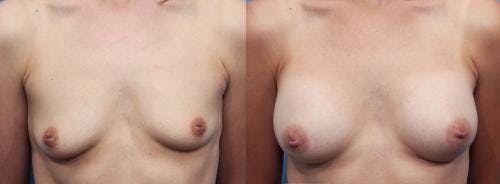 Breast Augmentation Before & After Gallery - Patient 58470476 - Image 1