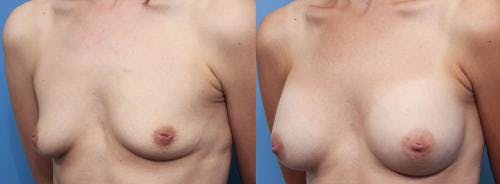 Breast Augmentation Before & After Gallery - Patient 58470476 - Image 2