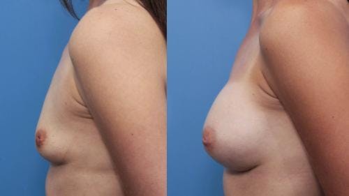 Breast Augmentation Before & After Gallery - Patient 58470476 - Image 3